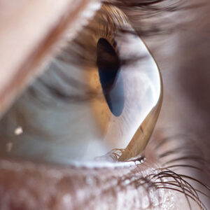 Keratoconus Treatment