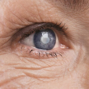 Glaucoma Treatment